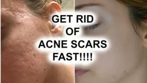 Acne Scars