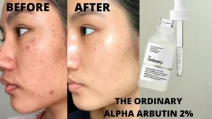 Skincare Products for Hyperpigmentation