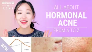 hormonal acne