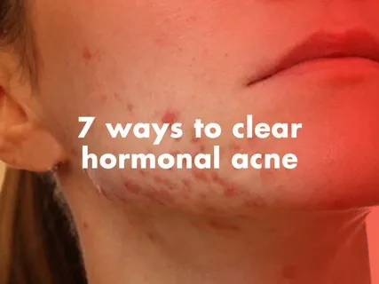 Is Hormonal Acne Getting Worse in Your 30s? How to Stop Flare-Ups Fast Hormonal Acne
