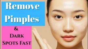 Stubborn Pimples