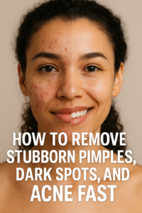 Remove Stubborn Pimples