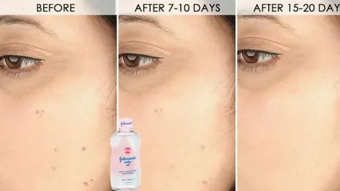 Facial Yoga to Treat Acne, Scars, and Pigmentation: Yoga for Skin Problems Facial Yoga